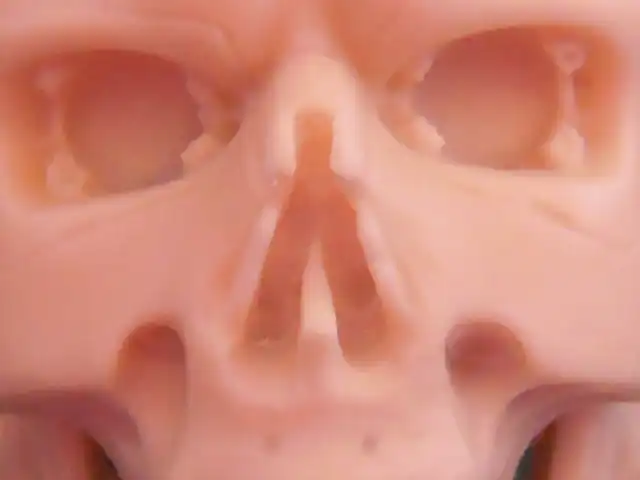 endoskull 013