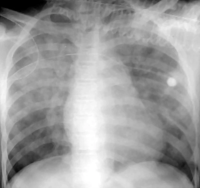 Edema alveolar no cardiogenico