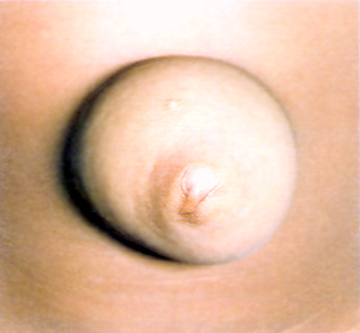 Hernia Umbilical Clinica