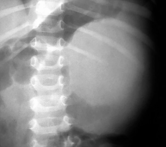 Neuroblastoma retroperitoneal Rx