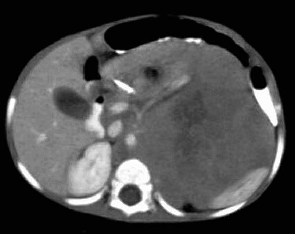 Neuroblastoma TAC