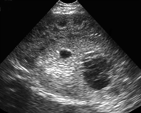 Neuroblastoma US