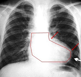 radiografia_tetralogia_Fallot