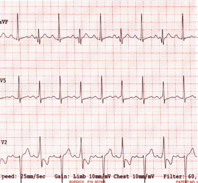 ecg2