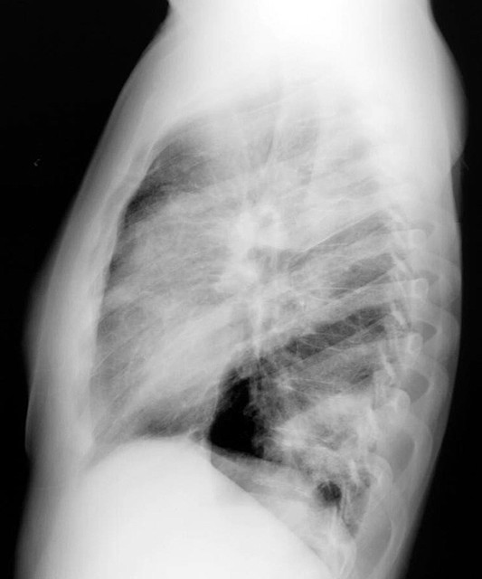 Neumonia eosinofilica P