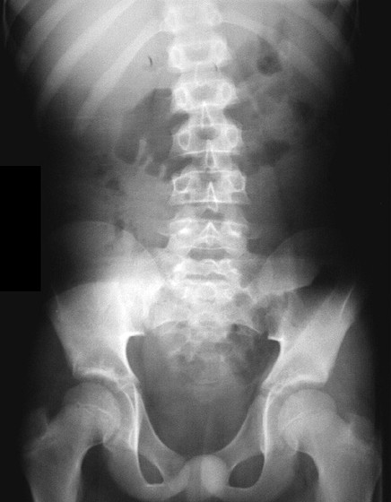 Borramiento psoas Rx