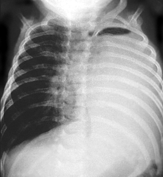 Hemitorax opaco cardiomegalia x coronaria izq aberrante