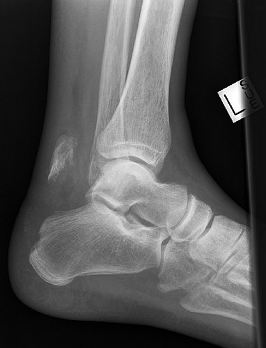 calcaneal-avulsion