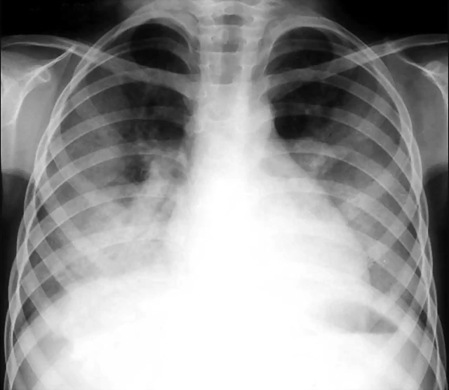 Hemosiderosis Episodio agudo RX1