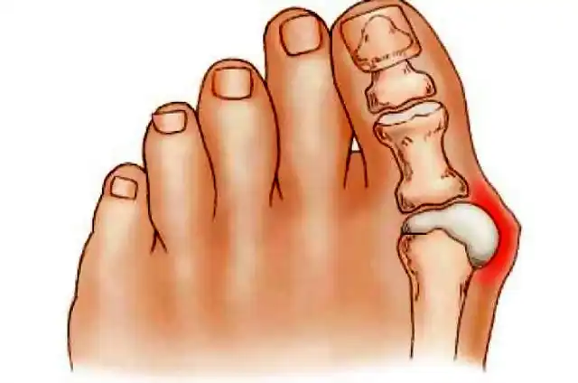 Juanetes-Hallux-Valgus-Deformidad-Dedo-Gordo (1)