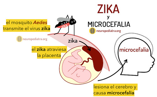 zika-y-microcefalia