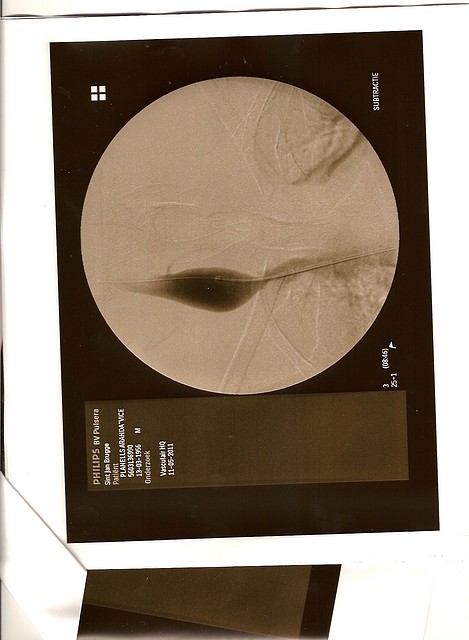 stenosis