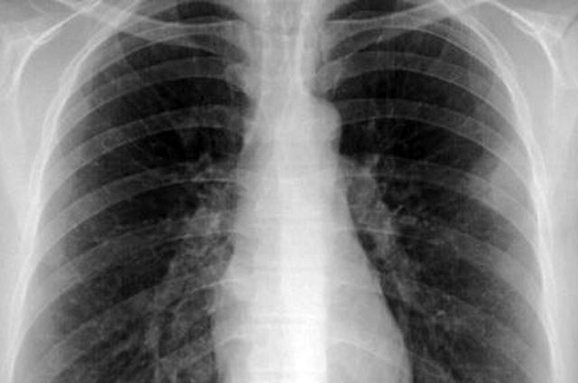 Hipertensin Pulmonar Enfermedad mortal y casi desconocida