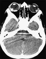 Abuso TAC Hemorragia retiniana 1