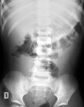 Absceso apendicularRx