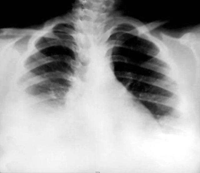 Derrame pleural bilateral