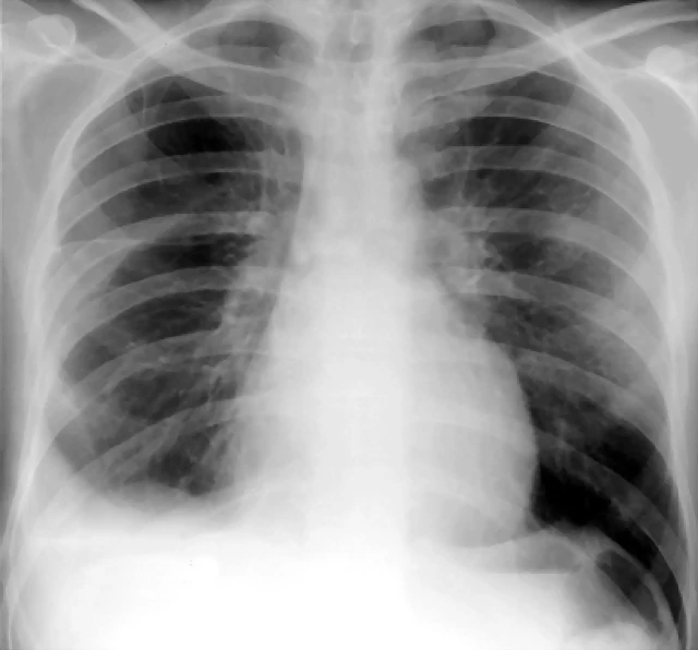 Derrame pleural der