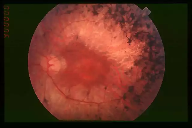 800px-Fundus_of_patient_with_retinitis_pigmentosa,_mid_stage