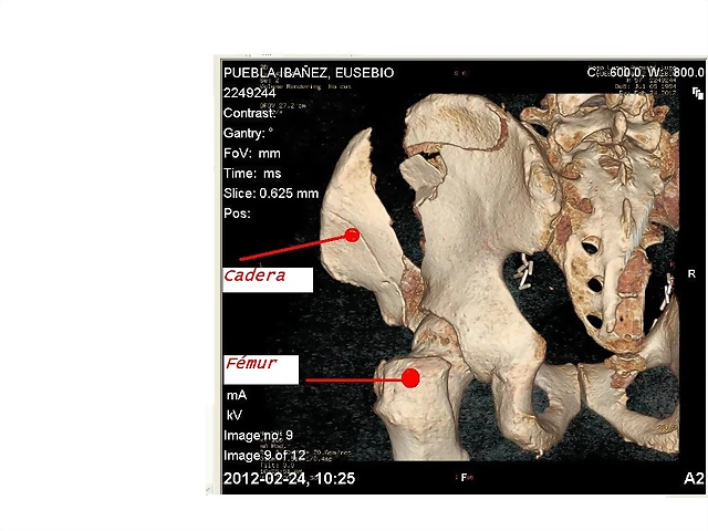 Pelvis II Pelvis II