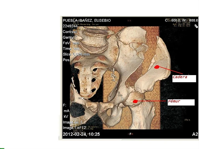 Pelvis I Pelvis I
