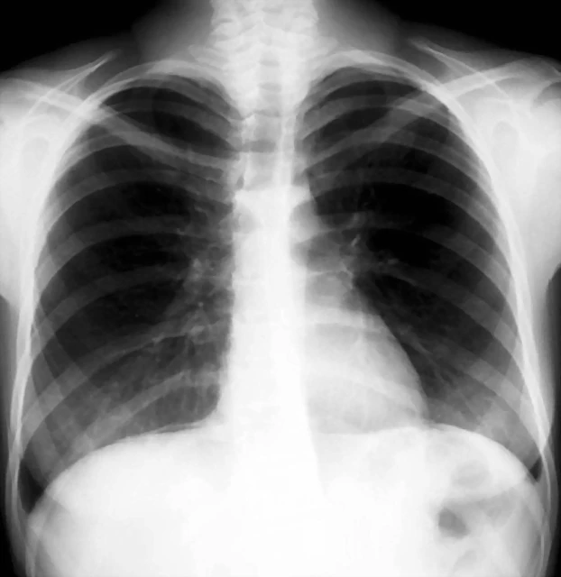 neumoperitoneominimo en RX de Torax F