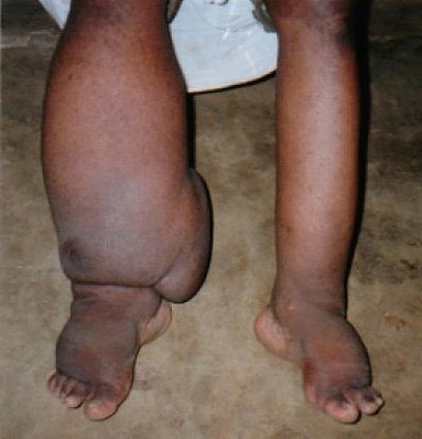 filariasis