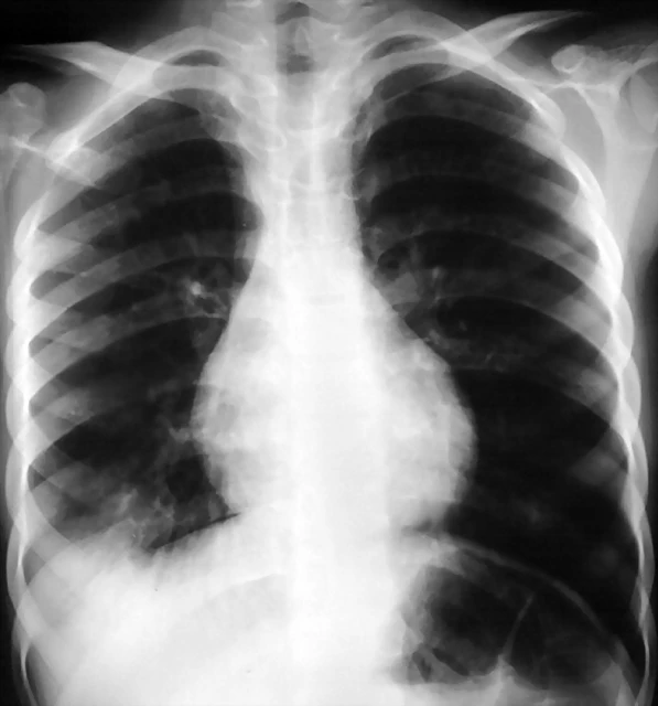 Infiltrado pulmonar agudo Rx 1