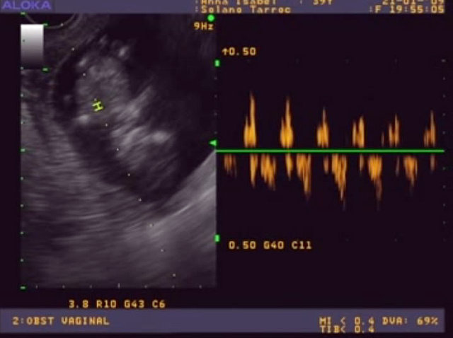 eco 12semanas 3 dias con doppler