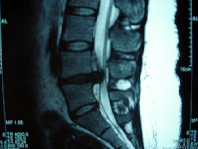 RMN COLUMNA HERNIA EXTRUIDA LATERAL