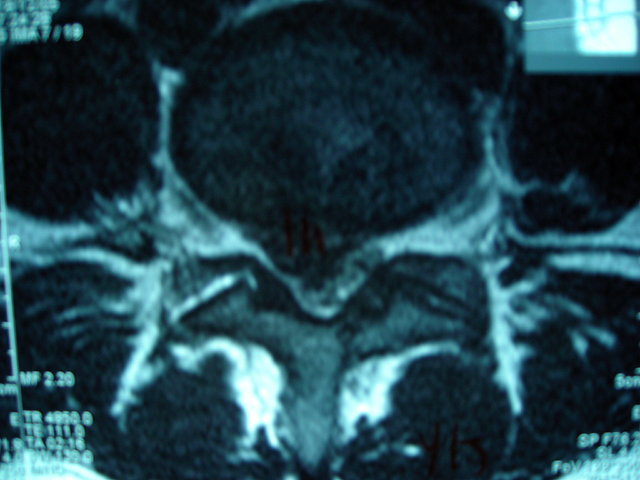 RMN DE COLUMNA HERNIA EXTRUIDA AXIAL