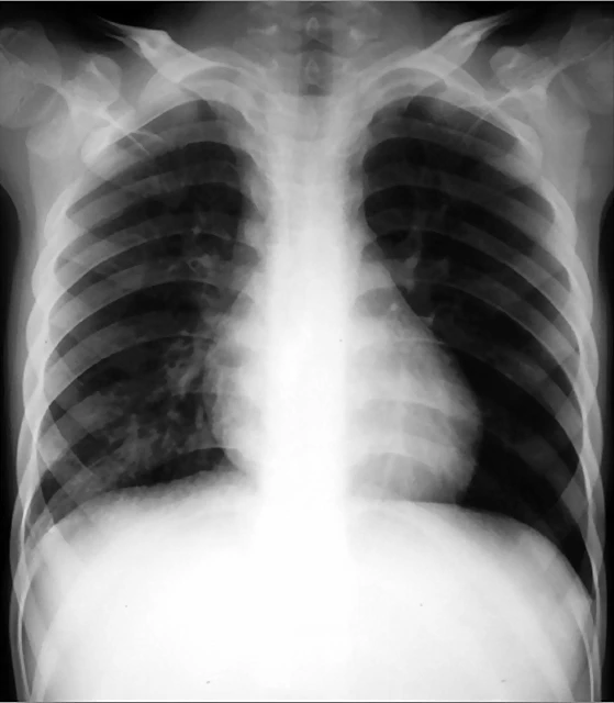 Infiltrado pulmonar agudo Rx 72hs