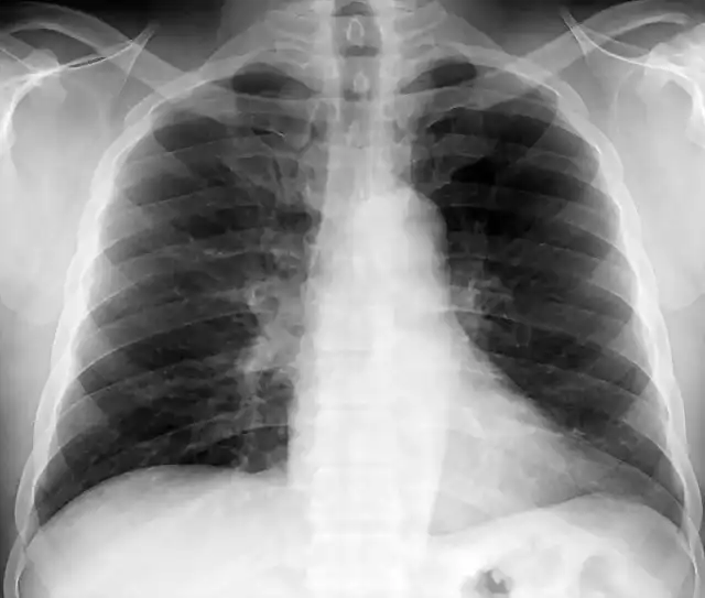 Asbestos Reaccion pleural mnima