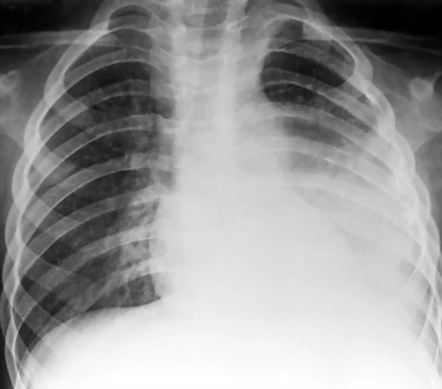 Neumonia estafilococcica c derrame