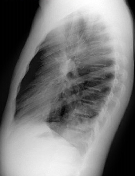 Bronquiectasias S Basal post Izq Rx p