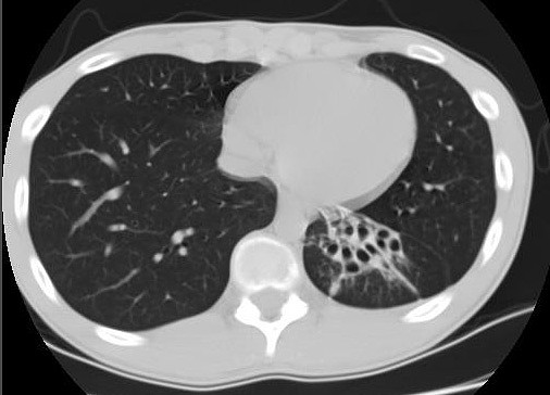 Bronquiectasias S Basal post Izq TAC1