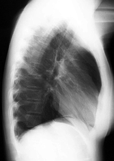 neumoperitoneominimo en RX de Torax P