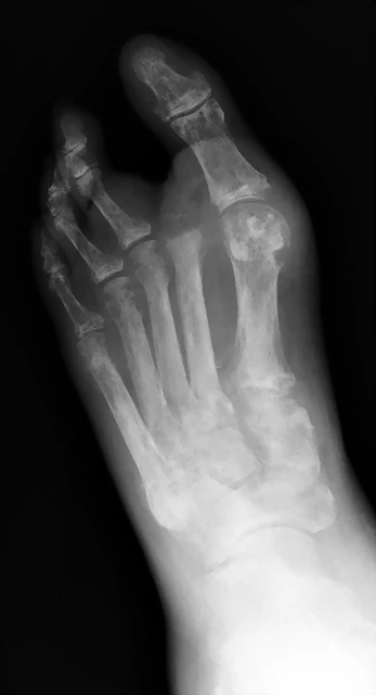 gout-plain-radiograph