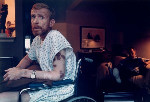 1986 La piel de Ken Meeks es marcada por las lesiones que provoca el Sida. San Francisco, California