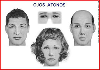 ojos ATONOS ojos ATONOS