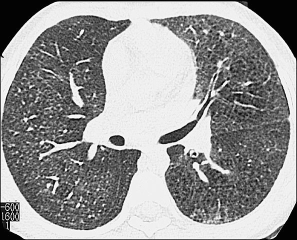 HemosiderosisTAC