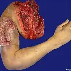 un a-brazo
