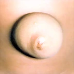 Hernia Umbilical Clinica