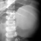 Neuroblastoma retroperitoneal Rx