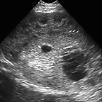 Neuroblastoma US