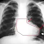 radiografia_tetralogia_Fallot