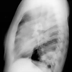 Neumonia eosinofilica P