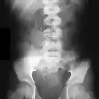 Borramiento psoas Rx