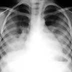 Hemosiderosis Episodio agudo RX1