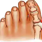 Juanetes-Hallux-Valgus-Deformidad-Dedo-Gordo (1)