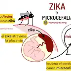 zika-y-microcefalia